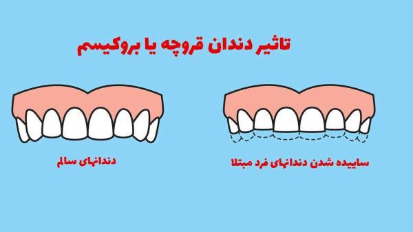 دندان قروچه شبانه چه علائمی دارد؟